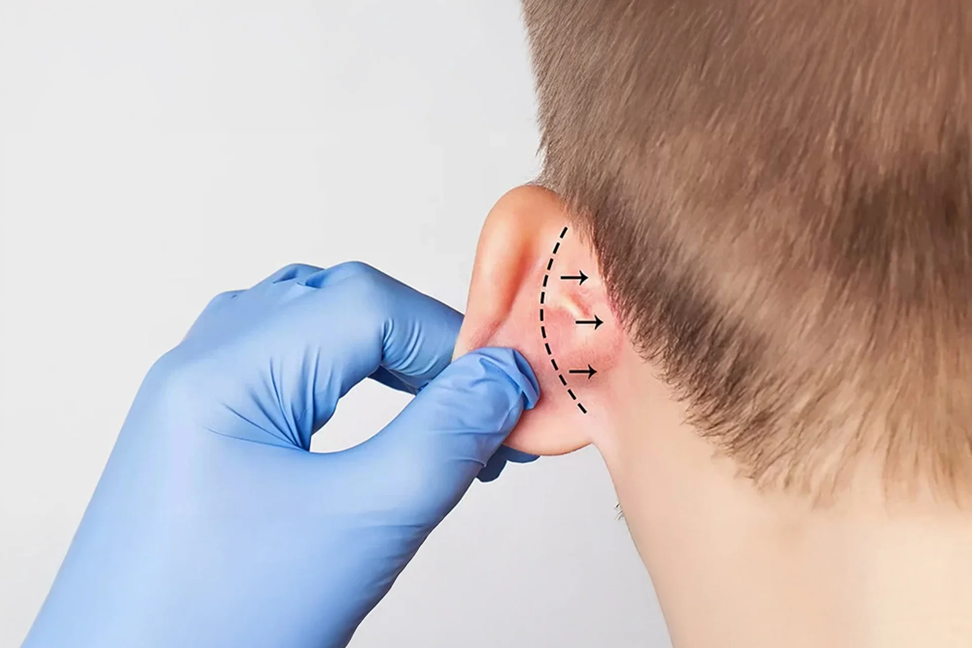 Antalya kepçe kulak ameliyatı Otoplasty in Antalya Otoplastik Türkei