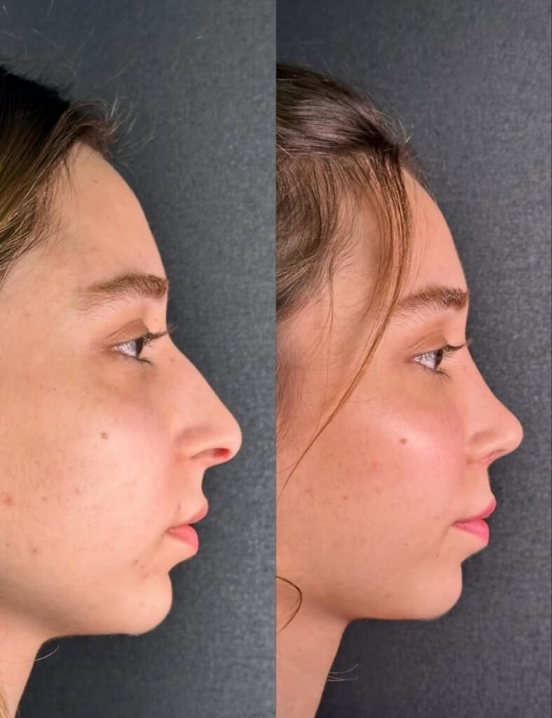 Antalya Burun Estetiği- Dr. Ekrem Korucuk