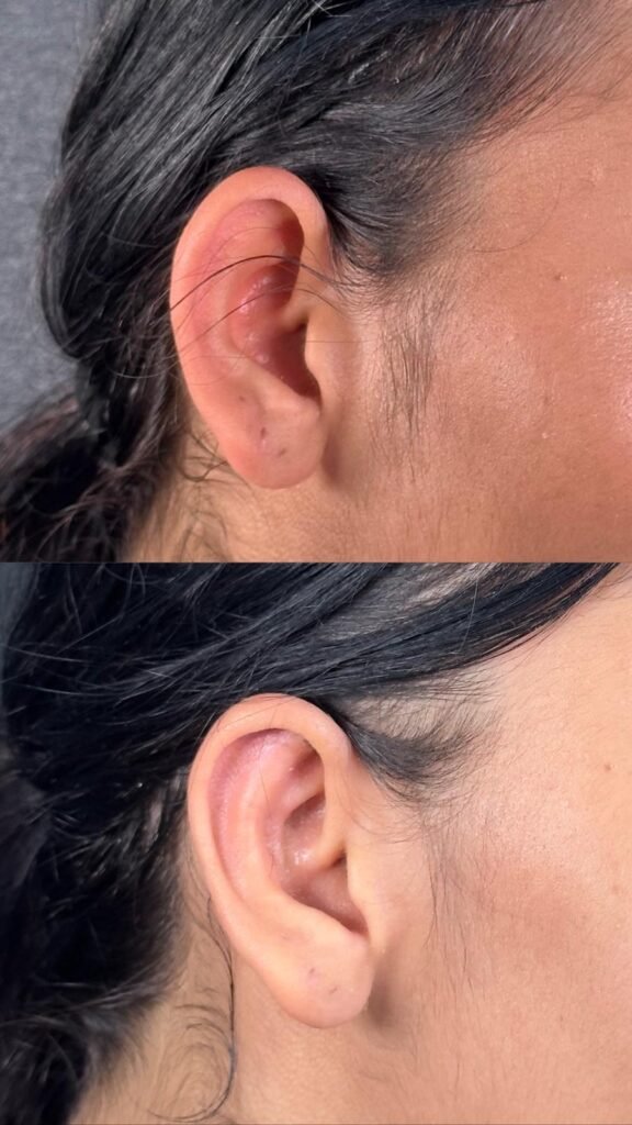 Antalya Kepçe Kulak Ameliyatı, Antalya Kulak Estetiği, Dr. Ekrem Korucuk, Antalya Otoplasti