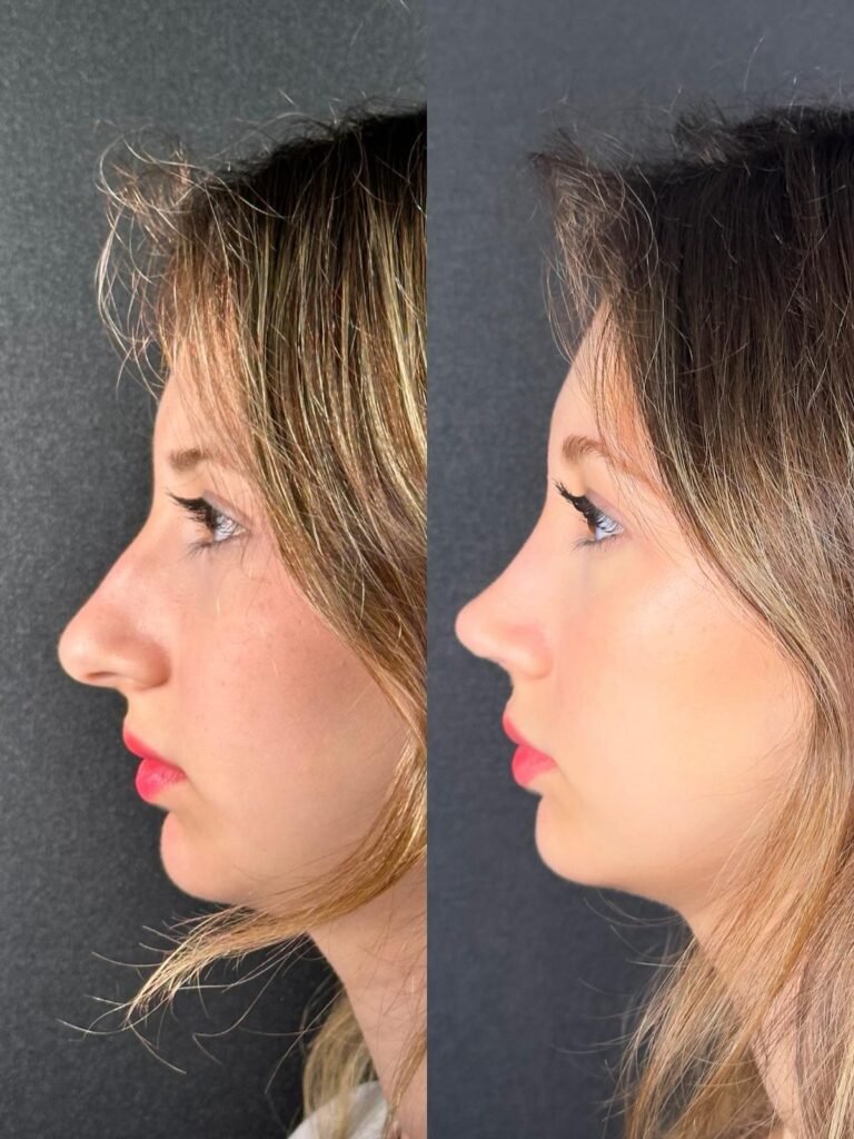 Antalya Burun Estetiği- Dr. Ekrem Korucuk