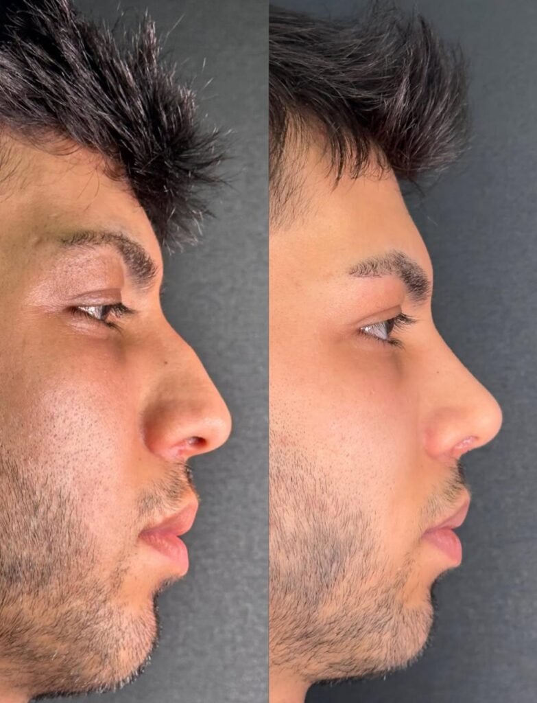 Antalya Burun Estetiği- Dr. Ekrem Korucuk